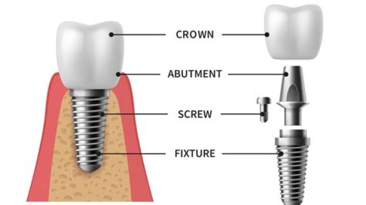 Bianca Censori Implants: A Comprehensive Guide to Her Journey and Achievements